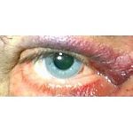 Injured Eye Detail